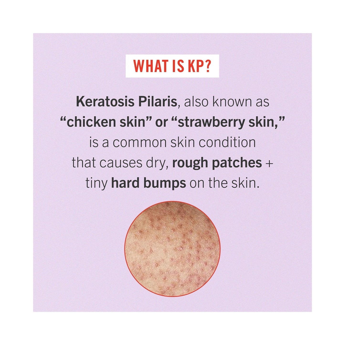 First Aid Beauty KP Bump Eraser Body Scrub With 10% AHA (226g)