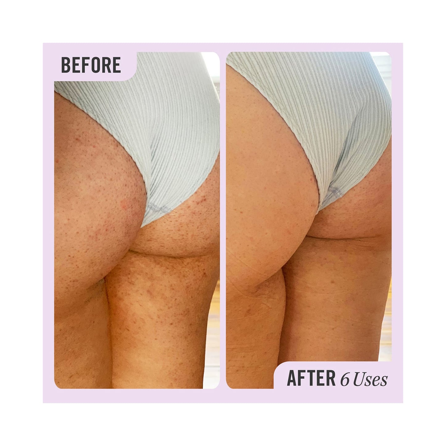 First Aid Beauty KP Bump Eraser Body Scrub With 10% AHA (226g)