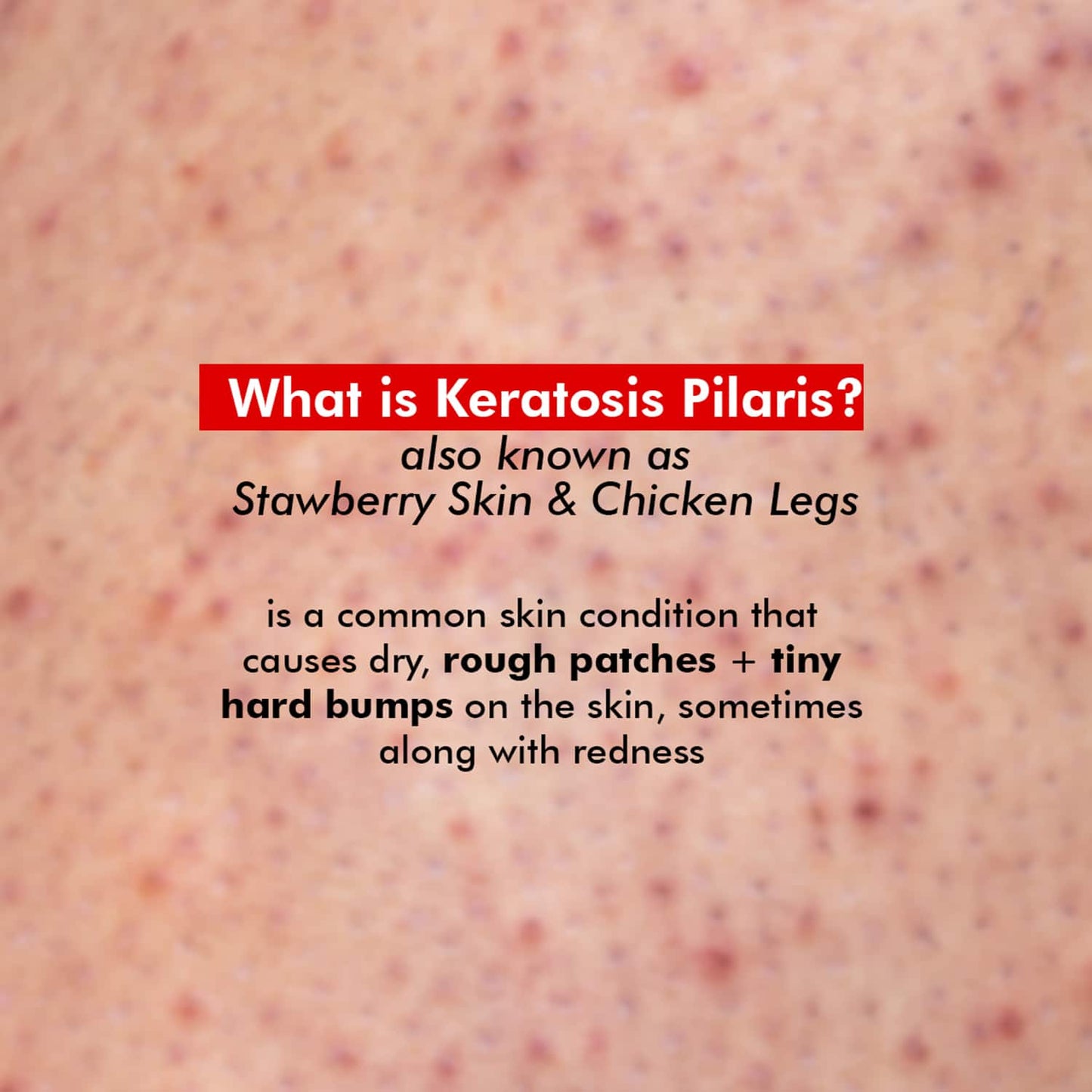 Conscious Chemist Body Exfoliating & Pigmentation Corrector Cream for Hard Bumps & Strawberry Skin